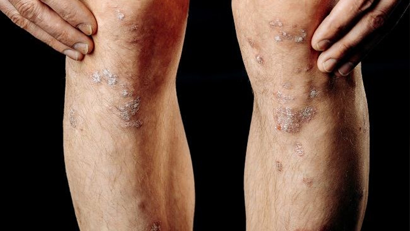 Kudis dan Scabies, Menular, Tapi Bisa Dicegah – PAFI Kota Pangkal Pinang